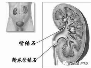 怎么判断是否得了肾结石？六大方法有效避免肾结石