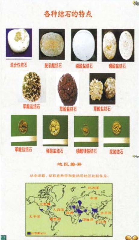 结石篇